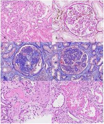 Case Report: Capillary Leak Syndrome With Kidney Transplant Failure Following Autologous Mesenchymal Stem Cell Therapy